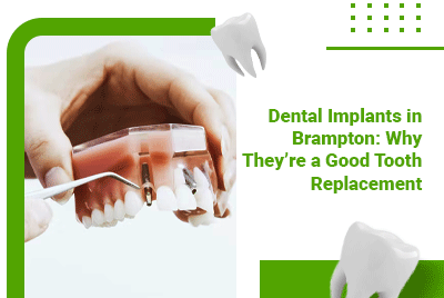 Dental Implants in Brampton: Why They’re a Good Tooth Replacement