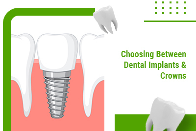 Dental Implants or Crowns in Brampton: Which Is Best for You?