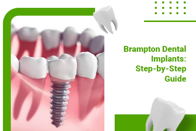 Brampton Dental Implants: Step-by-Step Guide & Expectations