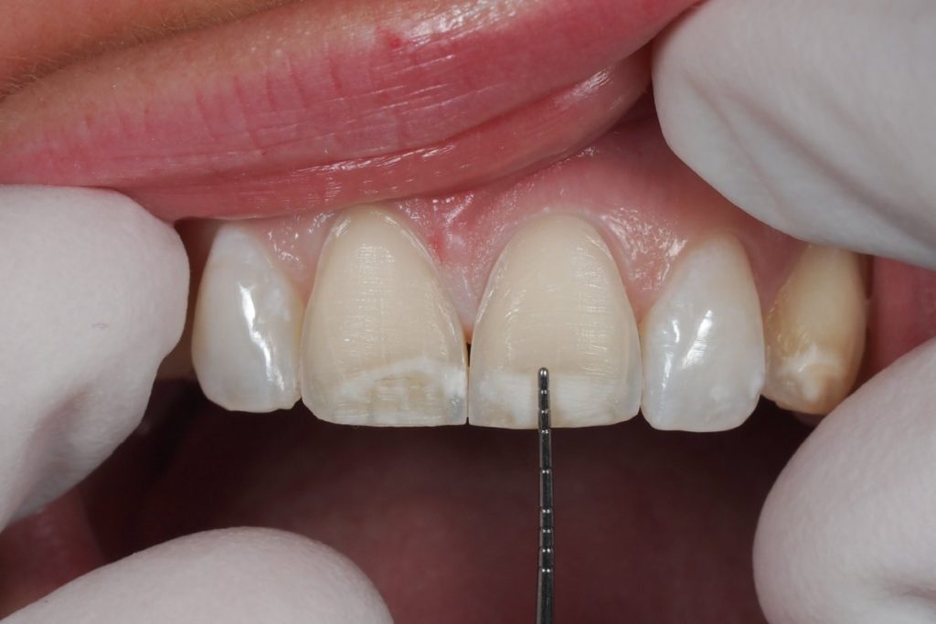 veneer type