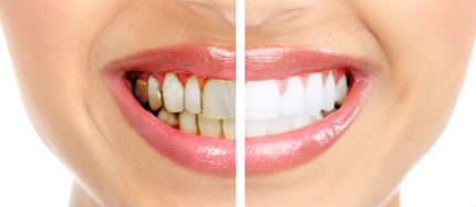 Tooth Enamel Erosion