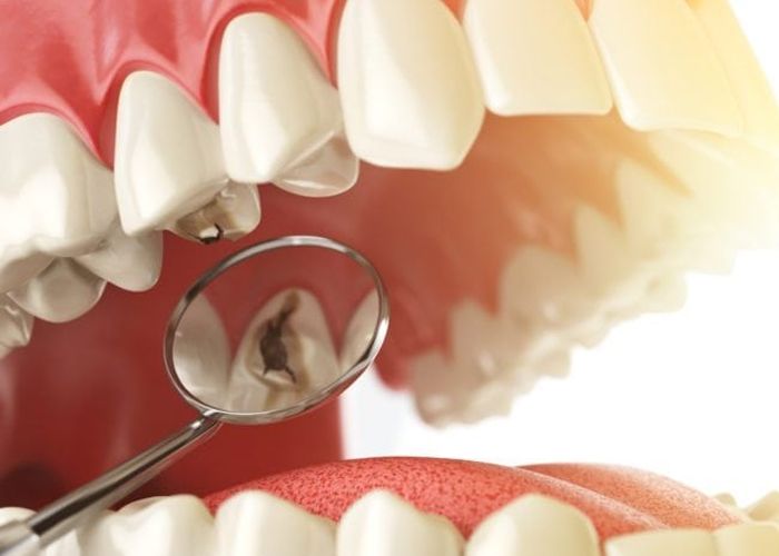 A Guide to Common Dental Problems and their Preventive Measures