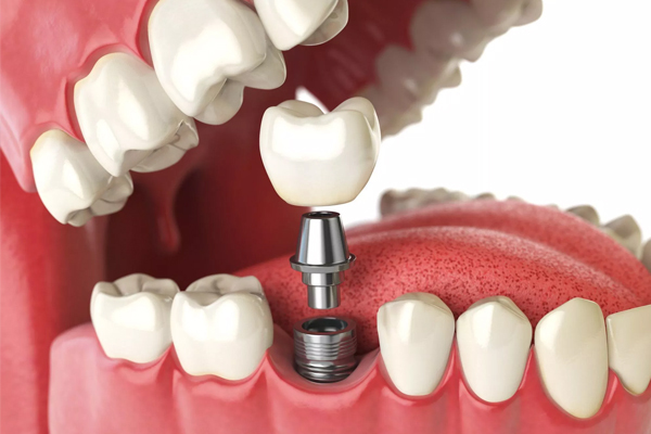 Heres Why You Should Consider Dental Implants