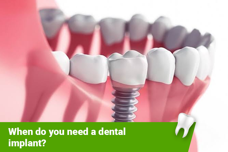 Dental Implants Brampton