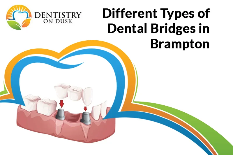 Types of Dental Bridges in Brampton