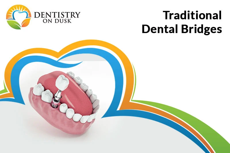 Dental Bridges