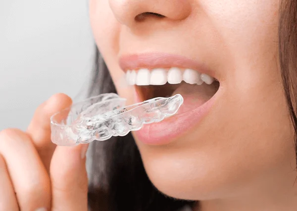 Aligners