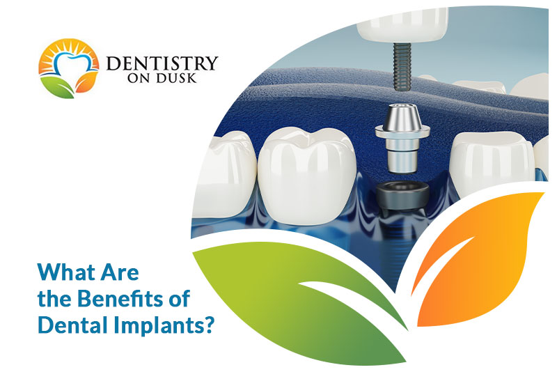 Benefits of Dental Implants